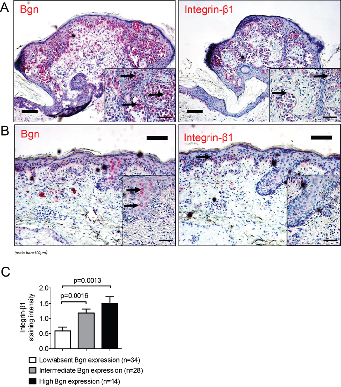 The levels of Bgn and integrin-&#x03B2;1 in melanoma tissue correlate.