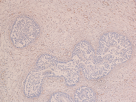 The epithelial cells of primitive IP were negative for progesterone receptor (immunoperoxidase; 100&#x00D7;).