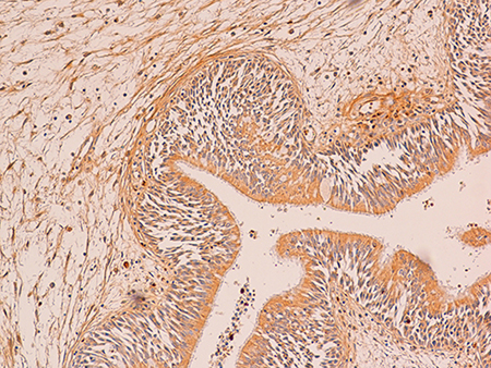 A case of relapsed IP with a low positivity for estrogen receptor (immunoperoxidase; 200&#x00D7;).