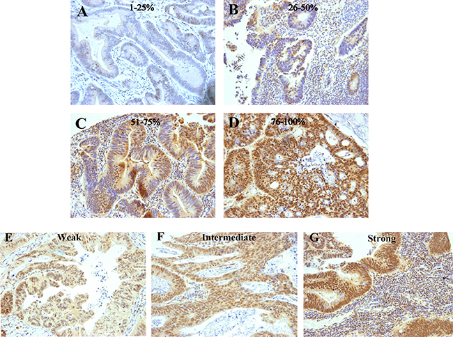 Examples of colorectal cancers immunostained for IRF-2.