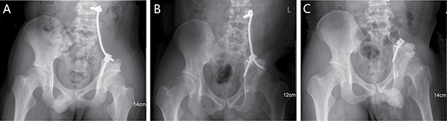 A 20-year-old male (case 25) with diagnosis of pelvis osteosarcoma affecting zone I.