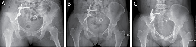 A 37-year-old female (case 26) with diagnosis of pelvis chondrosarcoma affecting zone I.