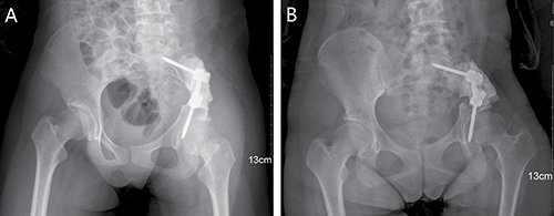 A 15-year-old female (case 28) with diagnosis of pelvis osteosarcoma affecting zone I.