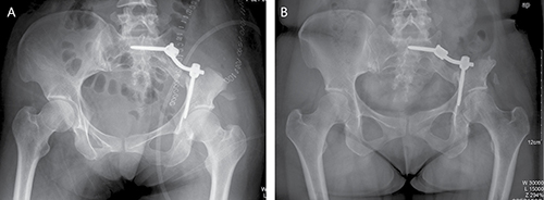 A 32-year-old woman (case 27) with diagnosis of pelvis chondrosarcoma affecting zone I.