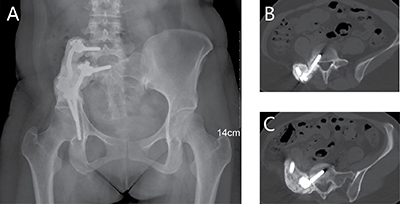 A 26-year-old female (case 1) with diagnosis of pelvis osteoclastoma affecting zone I.
