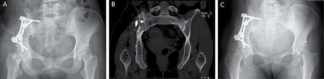 A 44-year-old woman (case 6) with diagnosis of pelvis osteoclastoma affecting zone I.