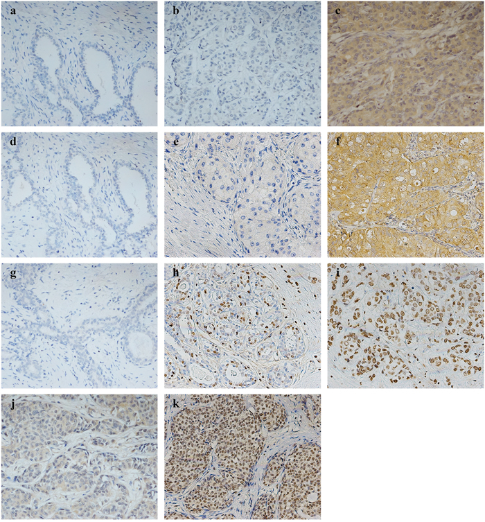 Representative pictures by immunohistochemistry for LAPTM4B, VEGF, and survivin in 110 breast cancer patients.