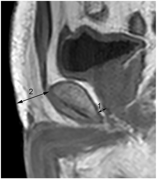 Subcutaneous and periprostatic fat thickness measurement on midsagittal dual-echo T1 weighted imaging.