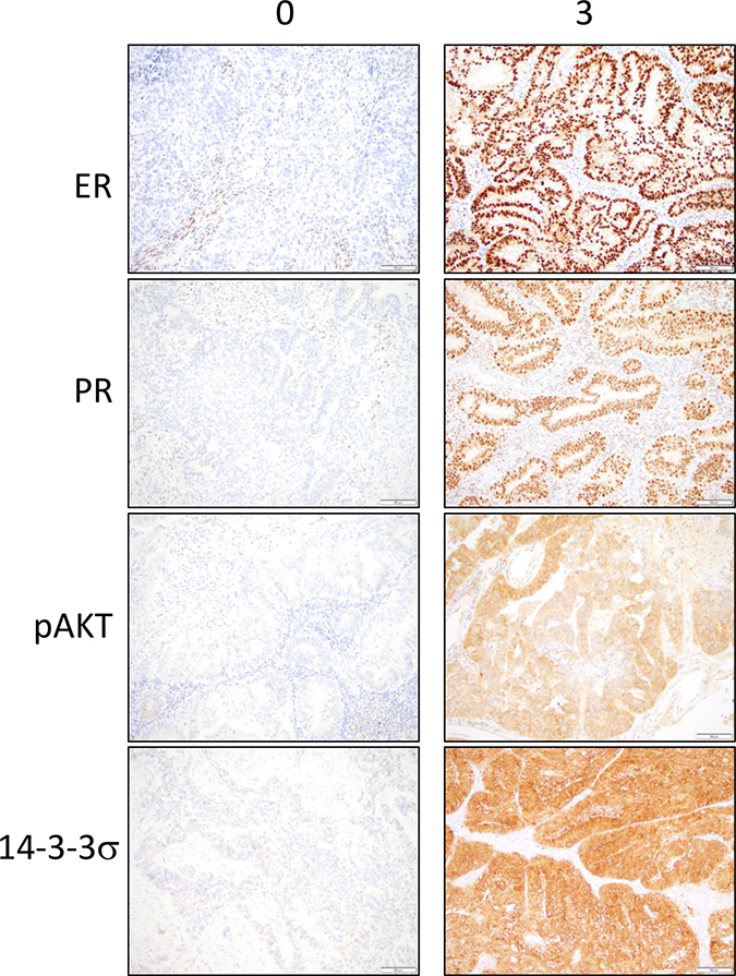 Immunohistochemical stainings for ER, PR, pAKT and 14-3-3&#x03C3; in the tumor epithelium are observed in tumor cores from the endometrial cancer tissue microarray.