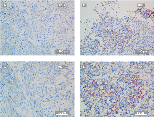 Representative IHC staining of PD-1 on recurrent NPC-biopsies.