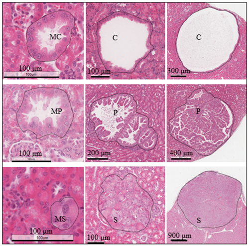 Renal tumours in Tsc2+/- mice.