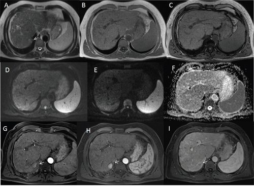 Man sixty-five years old with HCC on VII hepatic segment.