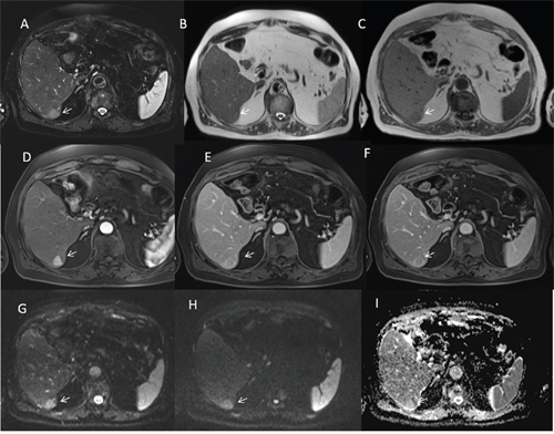 Man seventy-three years old with typical HCC on VI hepatic segment.