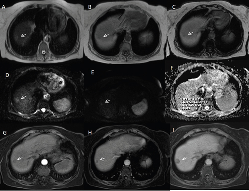 Woman fifty-three years old with atypical HCC on VII-VIII hepatic segment.