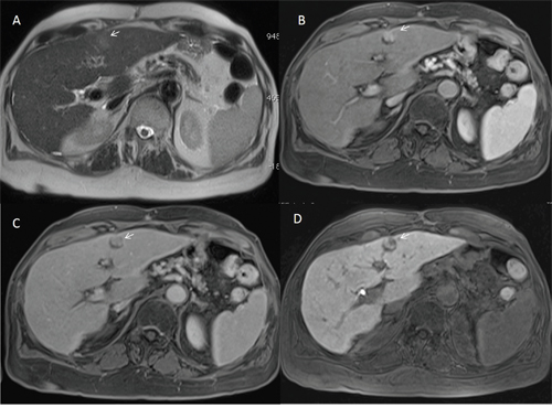 Man sixty-one years old with nodule of HCC in dysplastic nodule on II hepatic segment.