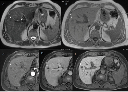 Man fifty-five years old with dysplastic nodule on V hepatic segment.