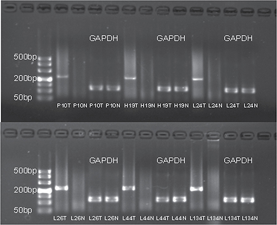 The agarose gel electrophoresis of the six samples with successfully validated fusion transcript CRYL1-IFT88.