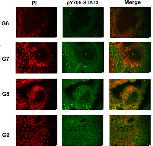 Analysis of pY705-STAT3 distribution in prostate cancer FFPE tissues Immunofluorescence staining of representative FFPE tissue sections with different Gleason score.