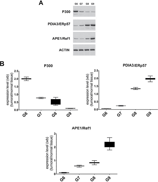 Analysis of STAT3 interactors in FFPE samples with different Gleason score.