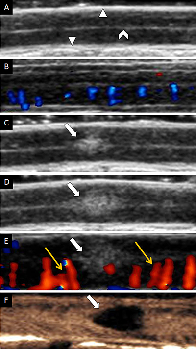 Ultrasound imaging of spinal cord on longitudinal view.