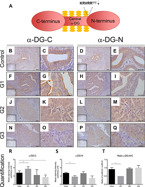 Representative images of immunolocalization of &#x03B1;-DG in the endometrium of post-menopausal women without (control) and with endometrial cancer.