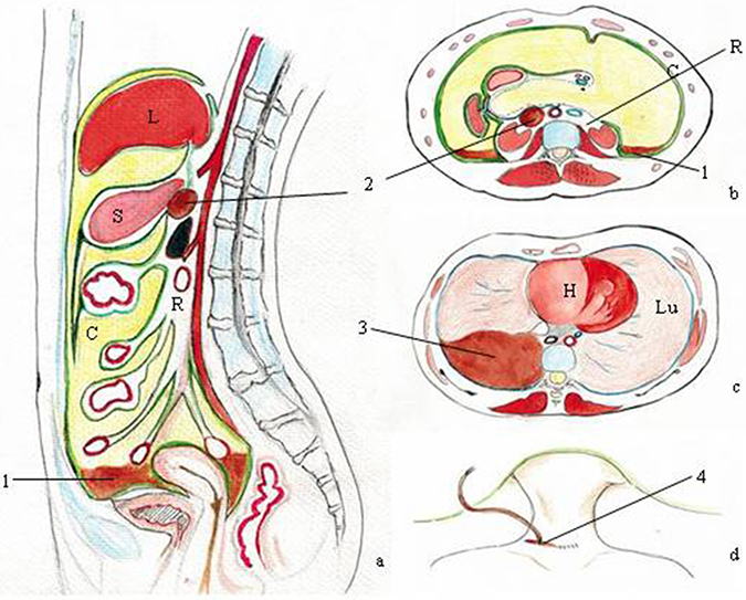 Pictured here is the postoperative lymphatic leakage.