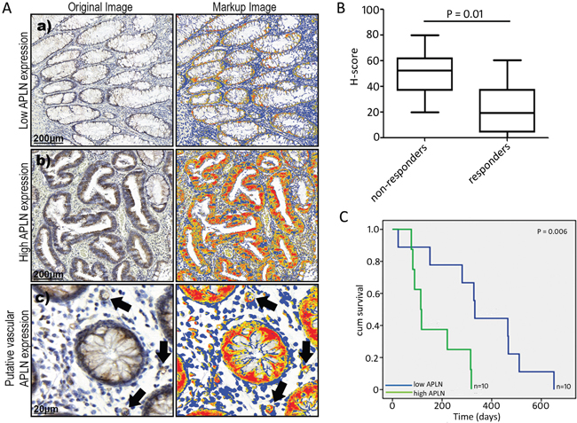 APLN protein expression in CRC tissues.