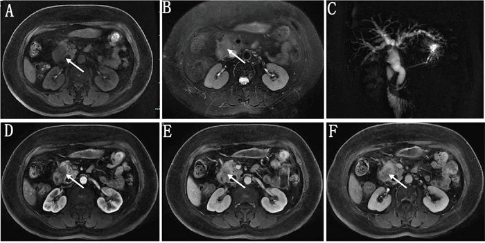 A 57 year old female patient with pathologically proven pancreatic ductal adenocarcinoma.