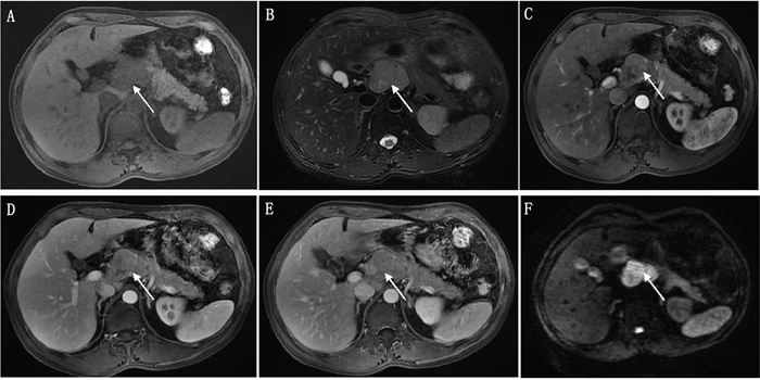 A 54 year old male patient with pathologically proven pancreatic neuroendocrine carcinoma.