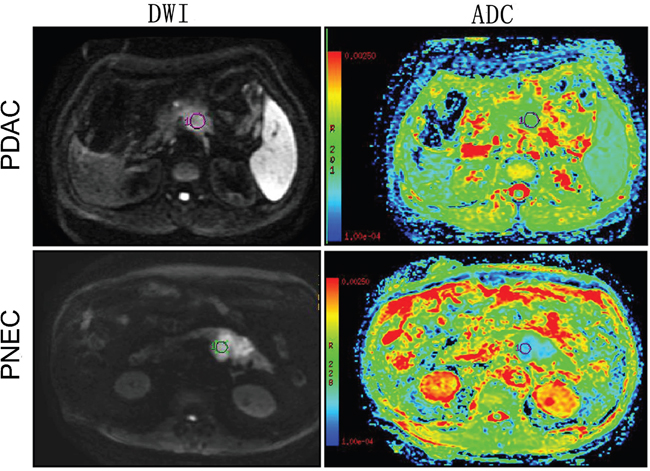 Diffusion-weighted images and ADC maps in pancreatic ductal adenocarcinoma (PDAC) and pancreatic neuroendocrine carcinoma (PNEC).