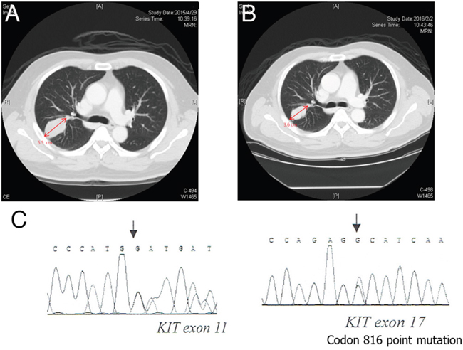 Regorafenib showed a treatment response in a patient with gastrointestinal stromal tumor with lung metastasis harboring a secondary mutation of exon 17.