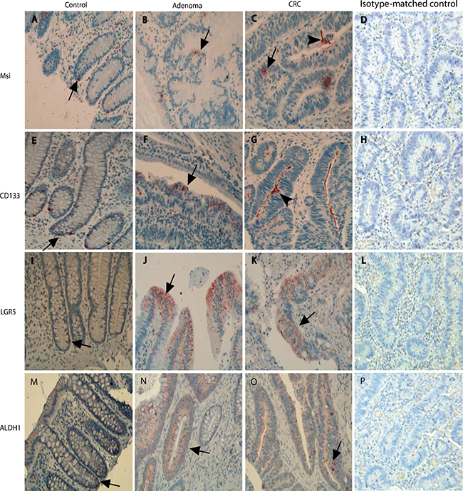 The presentation of stem-like markers Msi, CD133, LGR5 and ALDH1 in different stages of the adenoma-carcinomas evaluated with IHCs.