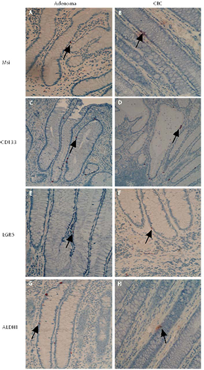 Changed presentation pattern of stem&#x2013;like markers in the transitional crypts close to adenomas and CRCs.