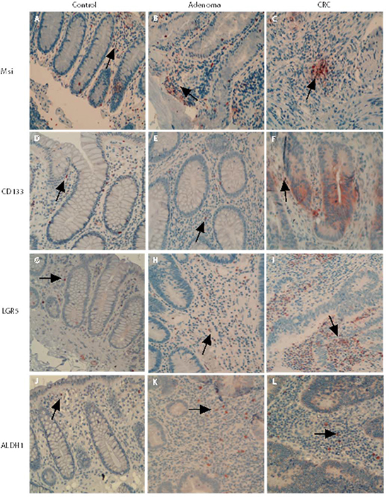 Mesenchymal stem-like markers in the adenomatous/cancerous tumor stroma.