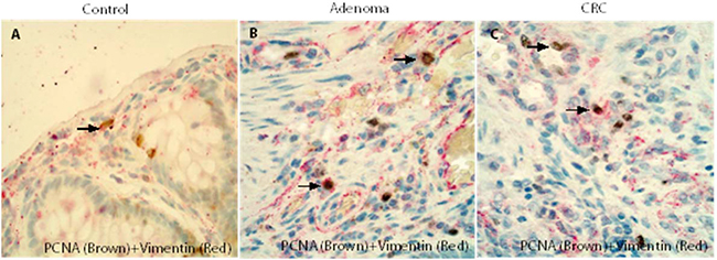 Double IHCs confirmed that fibroblasts in the adenoma/CRC stroma might have a high proliferative capacity.