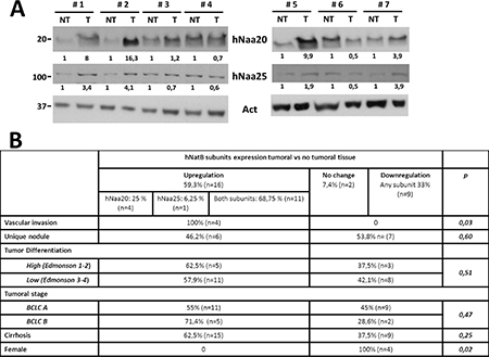 hNatB protein expression in human hepatocellular carcinoma (HCC) and non-tumor liver tissue.