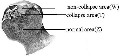 Bone tissues were taken from normal area, collapse area, and non-collapse area of femoral heads.