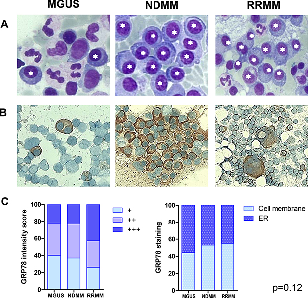 GRP78 expression in endoplasmic reticulum of plasma cells of patients with MGUS, NDMM and RRMM.