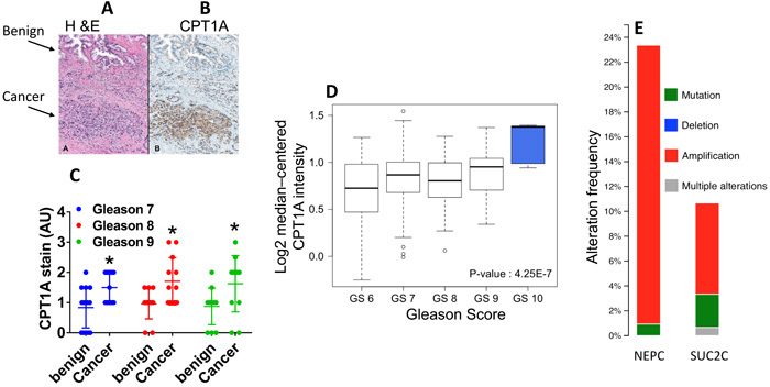 CPT1A expression is increased in advanced prostate cancer.