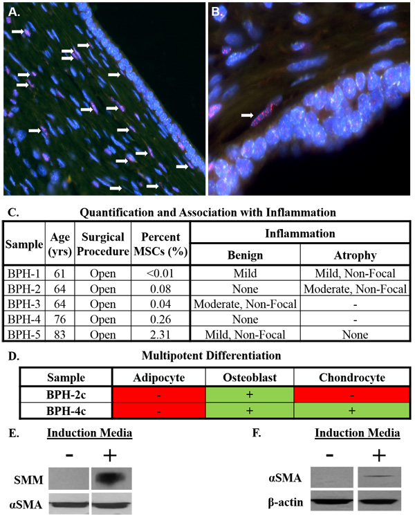 Stromal progenitors infiltrate prostate tissue and undergo smooth muscle differentiation, potentially contributing to benign prostatic hyperplasia (BPH) pathogenesis in the context of chronic inflammation.