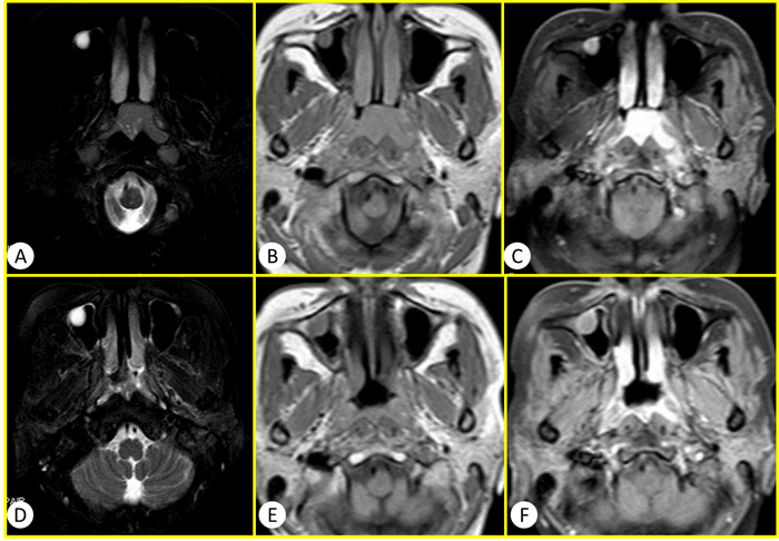 The conventional MR images of a 50 years old woman diagnosed as NPC.