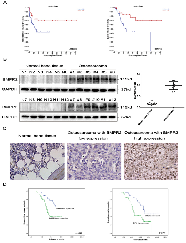 Elevated BMPR2 expression is predictive of poor outcome in osteosarcoma patients.