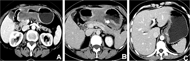 Contrast-enhanced computed tomography images of mucinous gastric carcinoma.