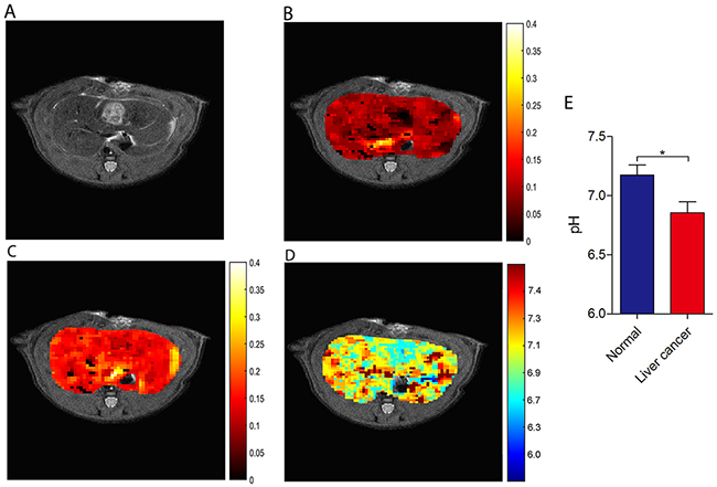 CEST imaging of liver cancer.