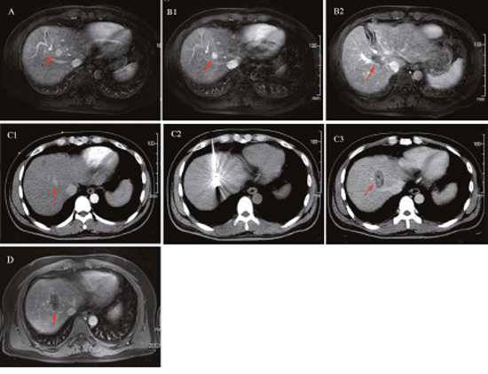 A 68-years-old male patient with primary liver S8 cancer underwent ultrasound-guided microwave ablation previously, but off-target effect appeared one month postoperatively.