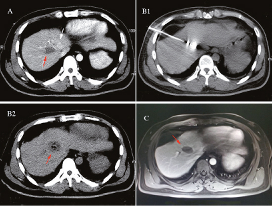 A 57-year-old female found a liver S8 metastatic tumor with diameter of 1.8cm 2 years after modified radical mastectomy of the left-side infiltrating ductal carcinoma received the ultrasound guided MWA.