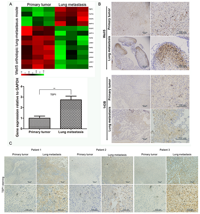 Expression of TSP1 in osteosarcoma tissues.