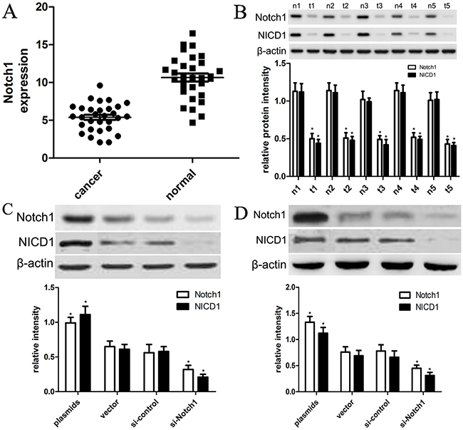The expression of Notch1 and NICD1 in liver cancer tissues and cells.