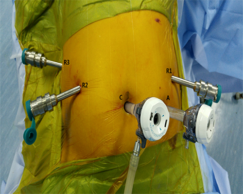 Trocar port placement in robotic distal pancreatectomy.