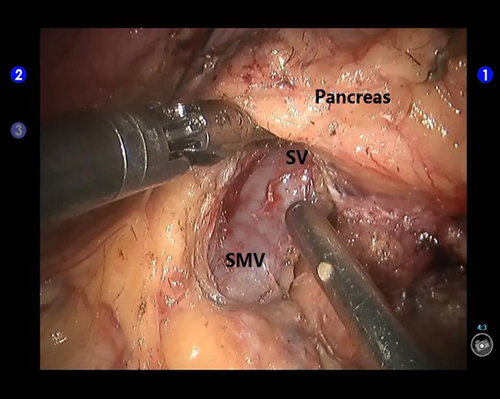 Creation of a retropancreatic tunnel during robotic distal pancreatectomy.